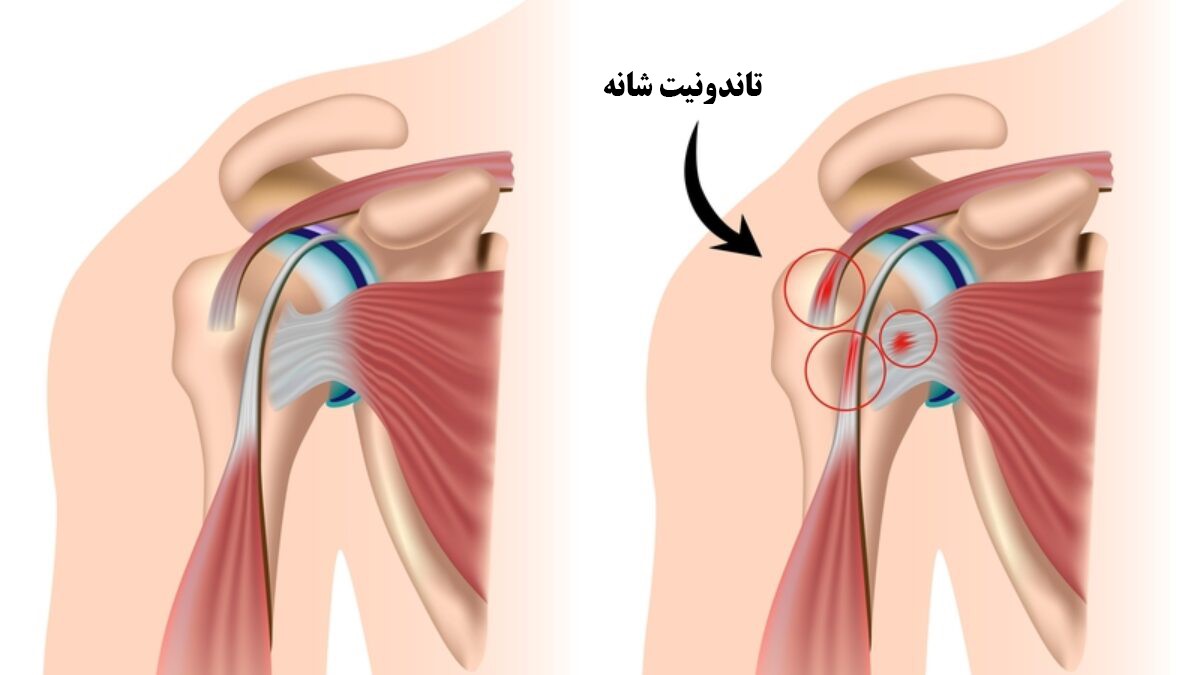 تاندونیت شانه چیست