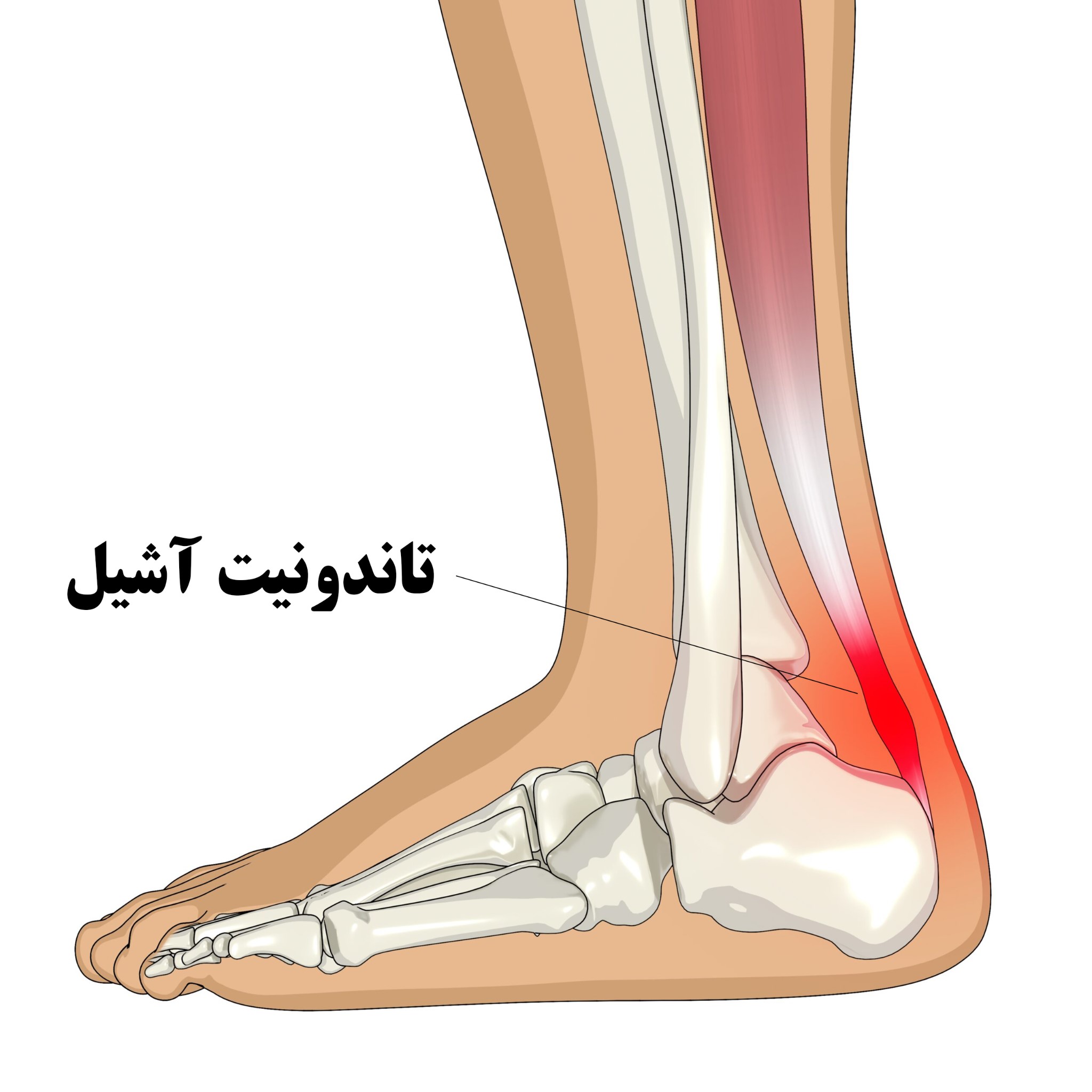درد آشیل پا چیست؟